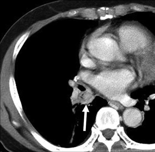CT scans show concentric wall thickening of the right bronchus intermedius (arrow in