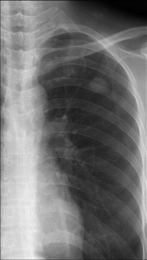 영상소견에서폐암의태성의폐결핵 A B C D Fig. 4. Pattern 3 (II): Poorly enhancing peripheral nodule with necrotic lymphadenopathy. A. Chest radiograph in a 37-year-old woman shows about a 1.