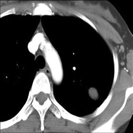 CT scan at the level of the aortic arch shows a poorly enhancing (mean HU: about 8) nodule in the apicoposterior segment of the left upper lobe. C.