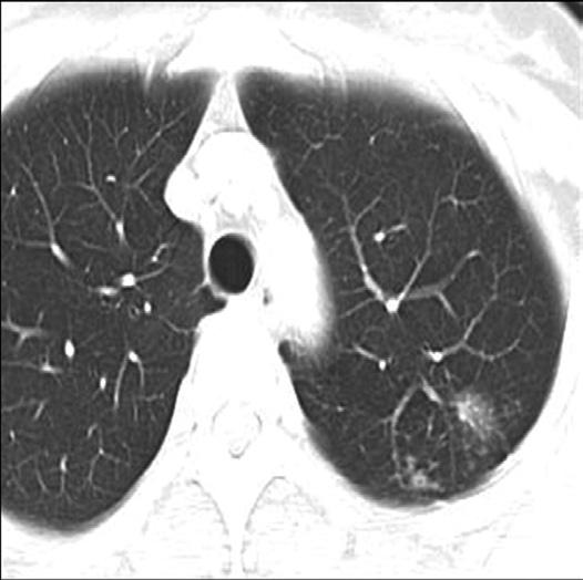 CT scan at a slightly lower level shows an enlarged lymph node (arrow) containing low attenuation necrotic portion with peripheral rim-like enhancement in the aortopulmonary window area. Note.