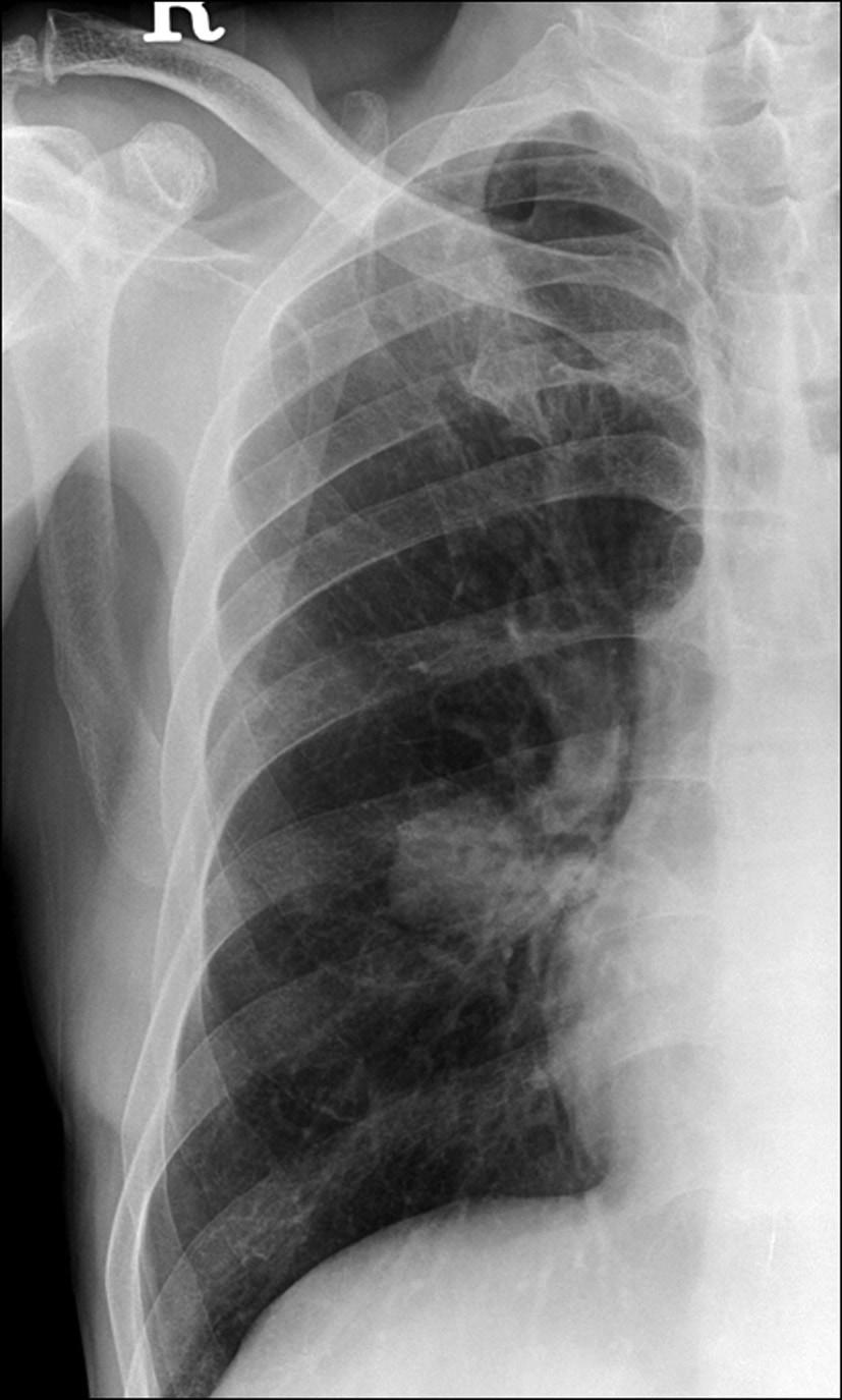 김형욱외 A B C Fig. 5. Pattern 4: Cavitary lesion with homogeneous low-attenuated wall. A. Chest radiograph in a 60-year-old man shows about a 3.