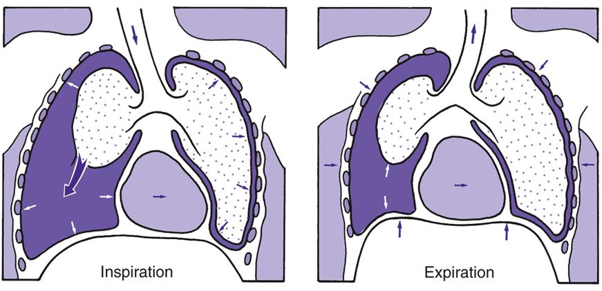 Pneumothorax (2 of 2) Tension pneumothorax( 긴장성기흉 ) 흉강내양압 (positive pressure) 발생