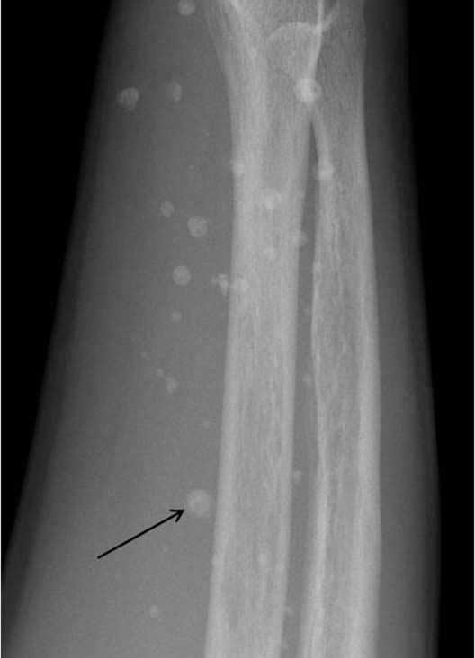 (arrow), suggesting thromboliths. Fig. 4. Renal osteodystrophy in a 48-year-old woman.