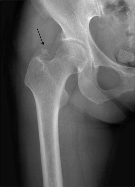 이연수 : 연부조직석회화병변의특징적영상소견 Fig. 7. Calcific tendinitis of the flexor carpi ulnaris tendon in a 36-year-old man.