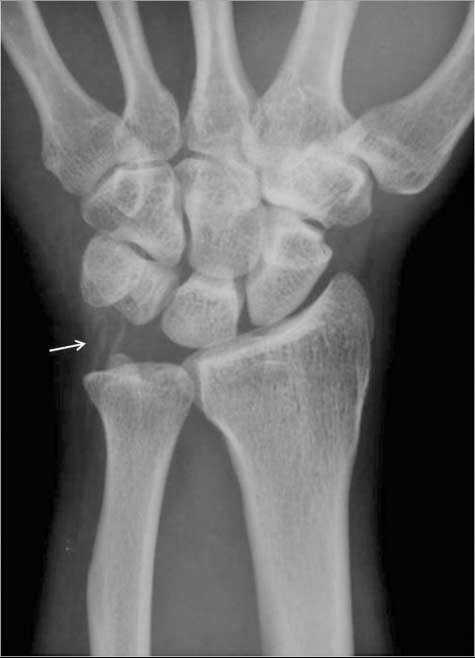 Calcific tendinitis of right hip in a 56-year-old woman.