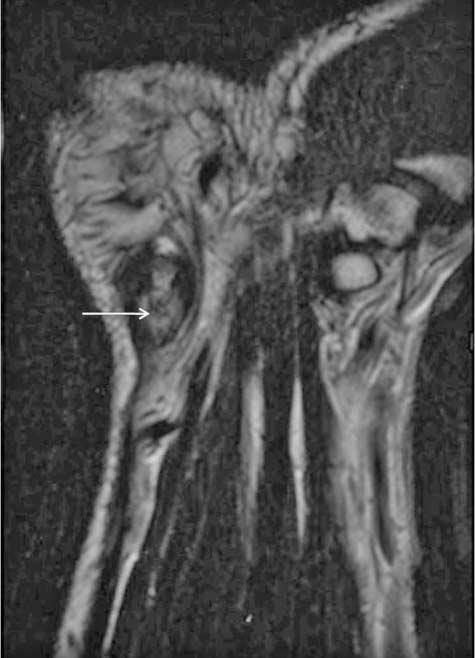 , C. Coronal () and axial (C) fat suppressed T2-weighted MR images of hip reveal the calcification (arrow) in the femoral