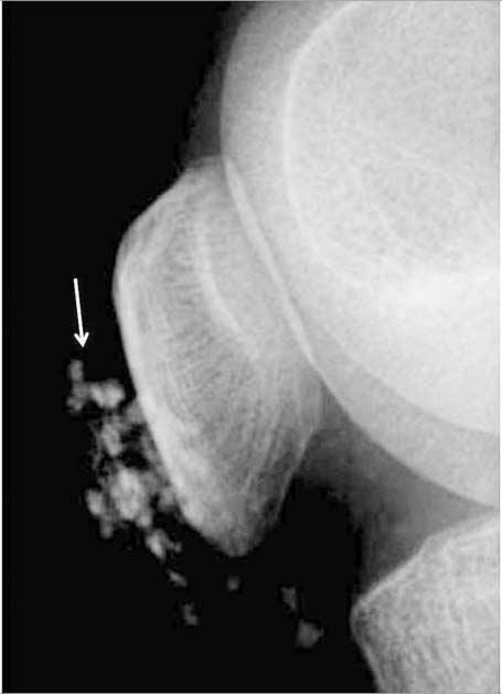 . Lateral radiograph of knee reveals stippled calcifications (arrow) in the subcutaneous tissue of prepatellar