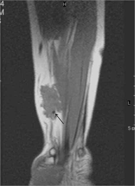 . Coronal fat suppressed T2-weighted MR image of knee shows a nodular dark signal intensity lesion (arrow) in the thickened medial collateral