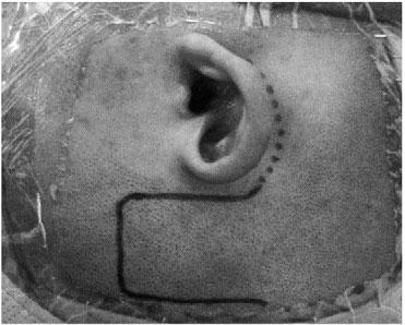 Facial Nerve Paralysis and Surgical Management T = tympanic segment, GG = geniculate