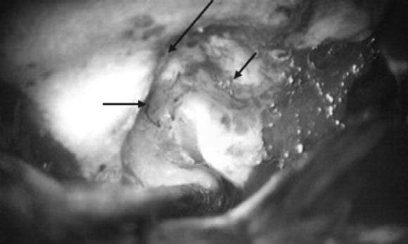 (A) The right facial nerve was injured near the geniculate ganglion; some granulation tissue is visible on the CT scan (red arrow).