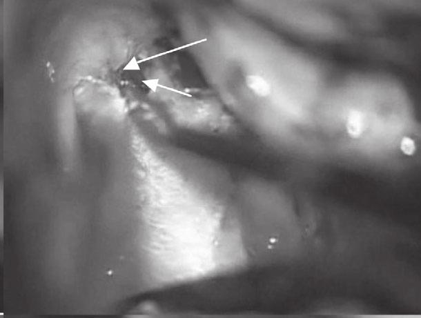 (A) After complete labyrinthectomy, it was shown that a thin bony wall covered the facial nerve