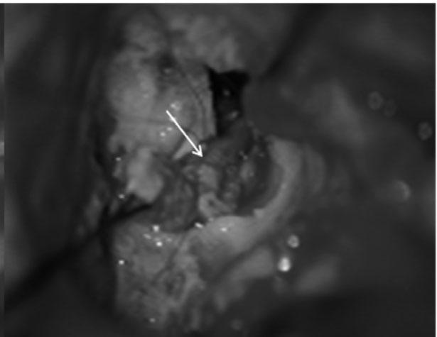 The surgical intervention of neural repair was employed via transmastoid approach. Closure without tension (white arrow).