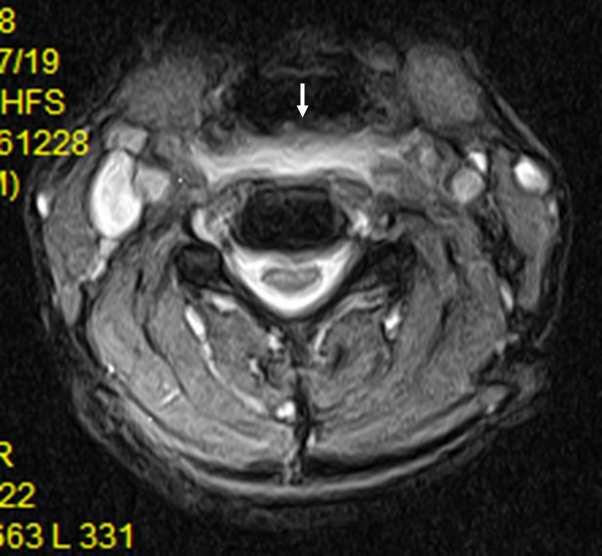 환자는당일 OO병원응급실처치후 2006. 03. 16 촬영한경추부자기공명영상 (Cervical MRI) 상경추부혈종 (Retropharyngeal hematoma) 진단하 (Fig. 2) 입원치료후혈종및통증이호전되었다.