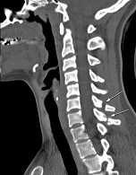 26 동일병원경추부컴퓨터단층촬영 (Cervical spine CT) 및자기공명영상 (MRI) 상경추 6, 7번극돌기골절진단되었으며, CT상 fracture margin 에약간의 sclerotic change 를보이고인접연부조직의부종이나출혈이뚜렷하지않다