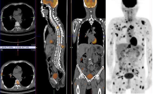 PET-CT