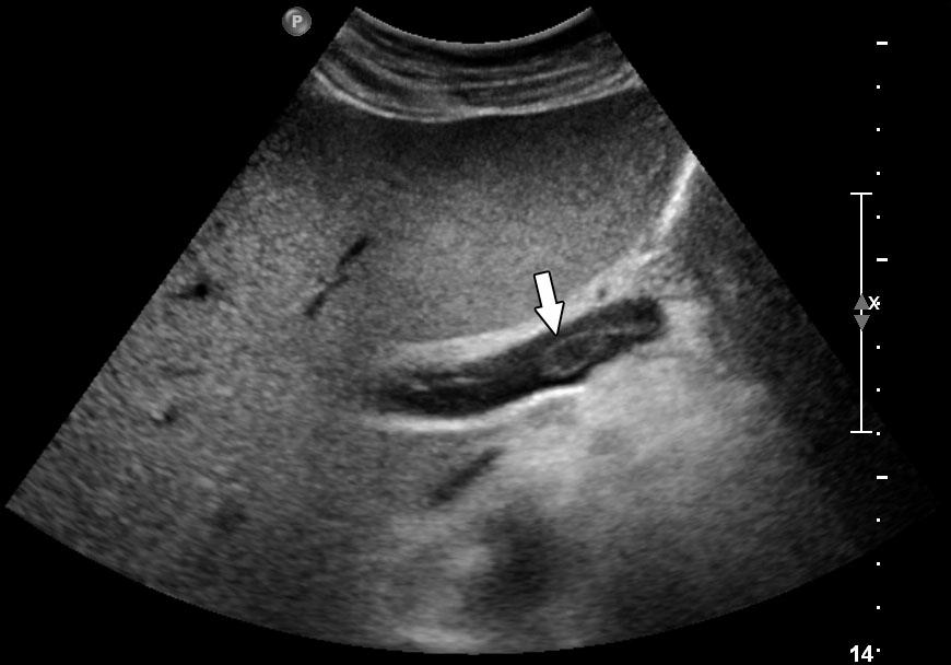 - 대한내과학회지 : 제 82 권제 1 호통권제 617 호 2012 - A B Figure 4. Follow-up abdominal and Doppler ultrasound.