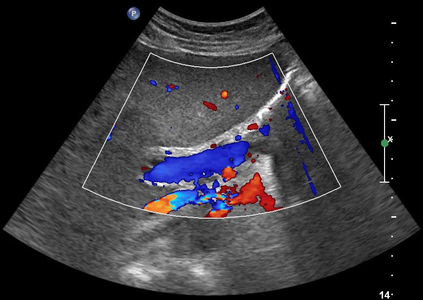 (B) Doppler ultrasound of the abdomen shows improved portal flow in the right main portal vein. 고찰간문맥혈전증은국소적이고, 전신적인혈전을유발하는인자들이야기하지만간경변증이중요한인자로여겨진다. 대상성간경변증을가진환자들에서혈전증의발생률은 0.
