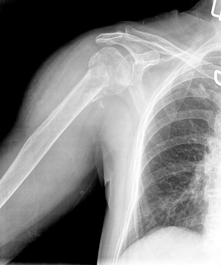 (4) 골절의고정 : 과거 cloverleaf, buttress, semitubular plate 등이많이사용되었으나최근에는골다공증이심한뼈에도견고한고정이가능한잠금금속판 (locking plates) 이이를대체하였다. 잠금금속판은골절부를안정화하기위해압박 (compression) 할필요가없고따라서골막을통한혈류가보존된다.