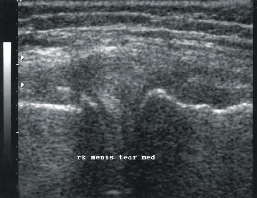 관절강의 협 출은 대퇴골과 경골을 잇는 선을 벗어나 측부인대 착은 아직 초음파상의 정확한 기준을 제시한 연구가 (collateral ligament) 등 주위 조직을 압박하여 변형을 Fig. 1.