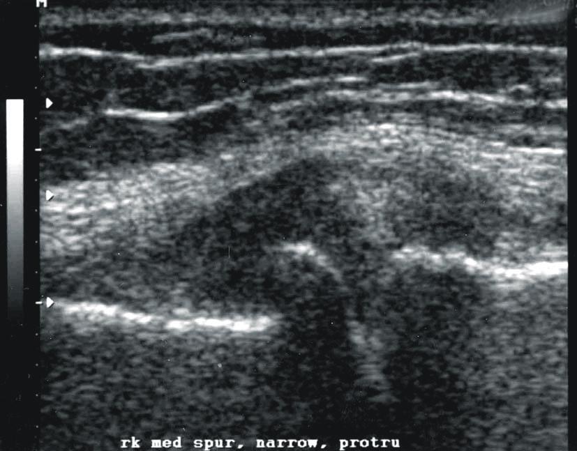 The coronal ultrasonography scan of medial compartment of the knee. This scan shows spur, medial meniscus protrusion and joint space narrowing.