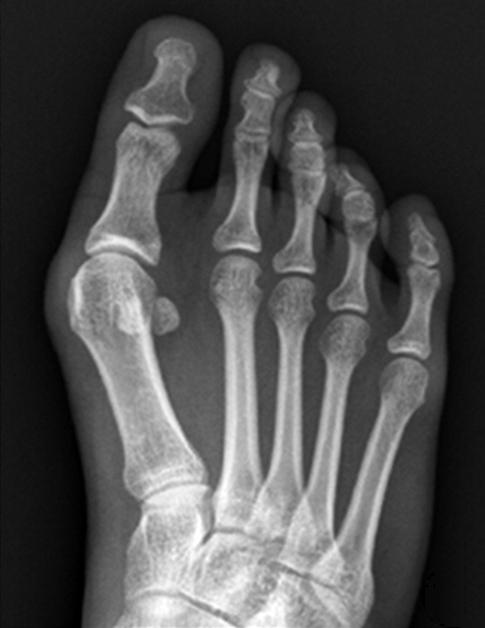 거골의 골연골 병변(Osteochondral lesion of talus, Lapidus procedure)은 제 1 족근 중족 관절 불안정증 OLT) 이 동반된 변형, 매우 심한