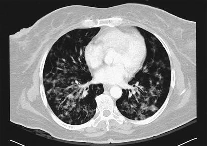 이후점차호전되는양상으로기계적환기구 (mechanical ventilator) 를제거하고일반병실로전동하였다가다시호흡곤란이발생하였고, 점차진행하여사망하였다. 고찰 Figure 3. Chest CT scan shows multiple small nodules with interstitial thickening.