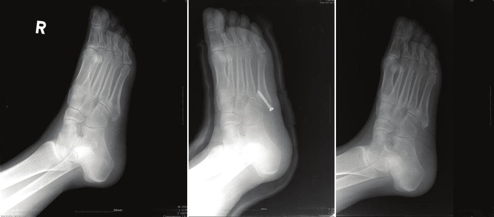 50 year old woman with avulsion fracture. (A) Initial foot oblique view with 3.9 mm displacement.