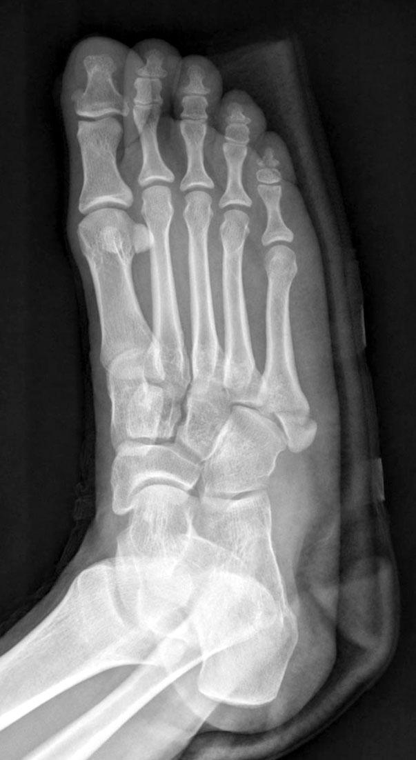 Vol. No., arch igure. (A) A -year-old woman with displaced intraarticular avulsion fracture of the fifth metatarsal.