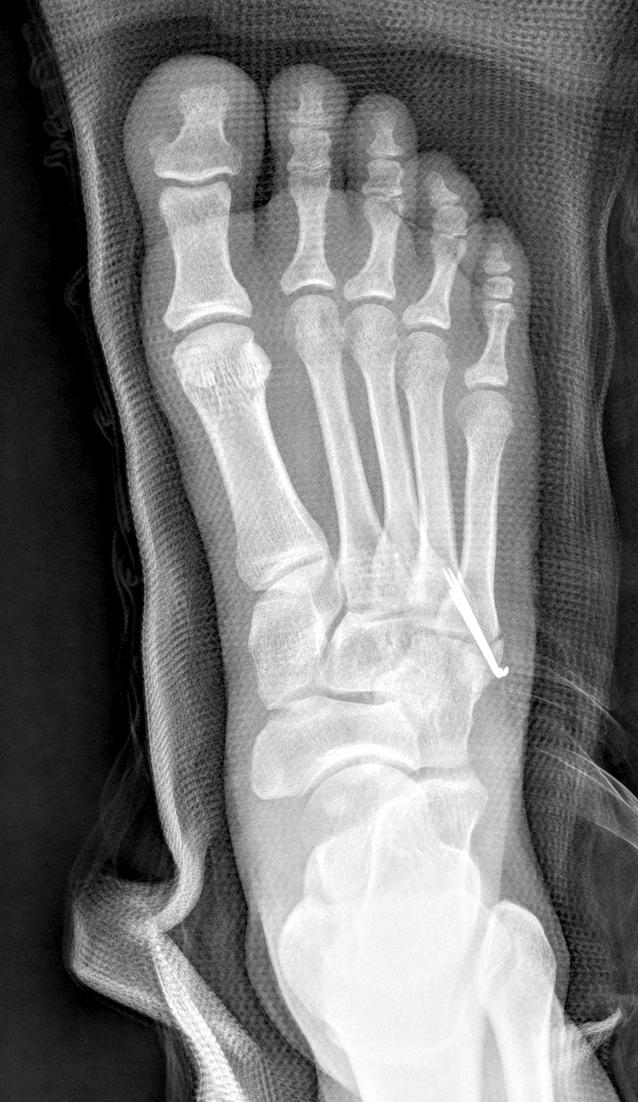 (C) mmediate postoperative foot oblique image showing anatomically reduced fifth metatarsal base fracture. (D) inal foot oblique image after implant removal months postoperatively.