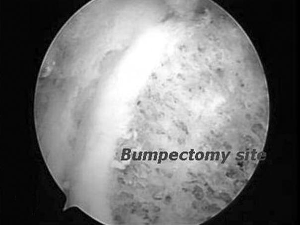 (B) Partial labrectomy and acetabular trimming was performed. (C) Femoral head neck junction bump was found.