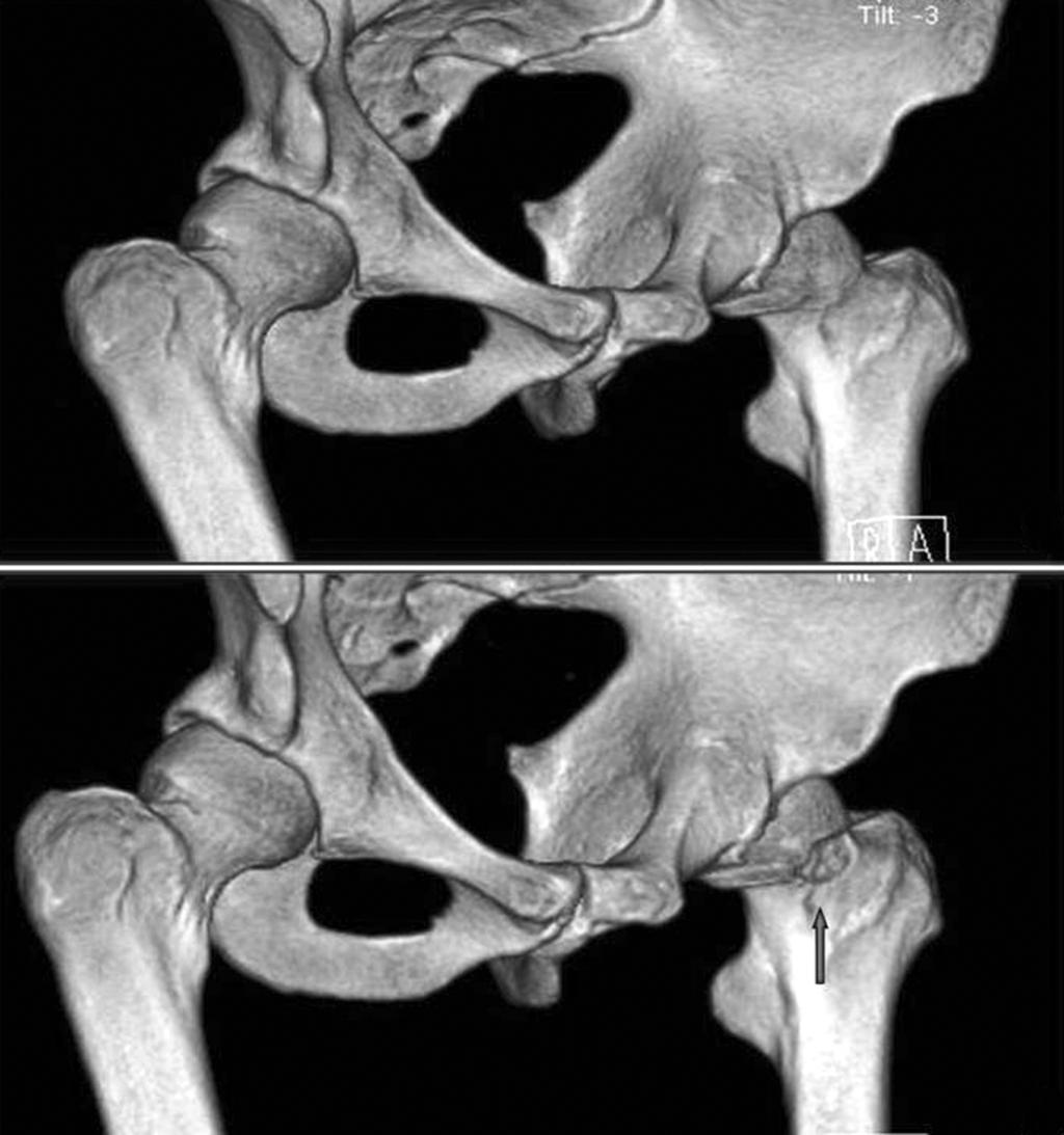 191 대퇴 비구 충돌의 관절경적 치료: 2-5년 추시 결과 Figure 4. Comparison of preoperative and postoperative hip CT images. (A) preoperative CT, (B) postoperative CT.