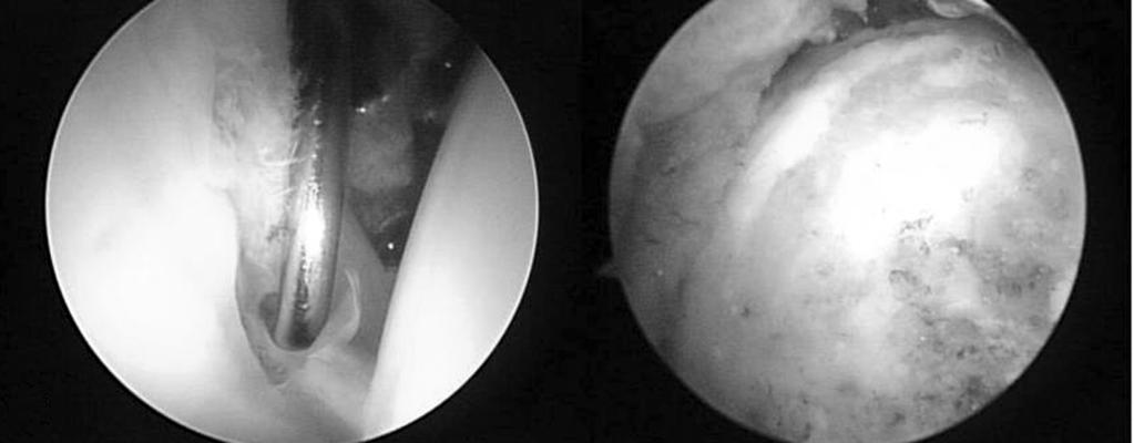 (C, D) Arthroscopic partial labrectomy and femoroplasty was performed. 2예, 동측 원위 대퇴골 박리성 골연골염으로 수술한 환자 1예, 요 으며, 전 예에서 활액막 증식 및 비후 소견을 보였다(Fig. 7, 8).