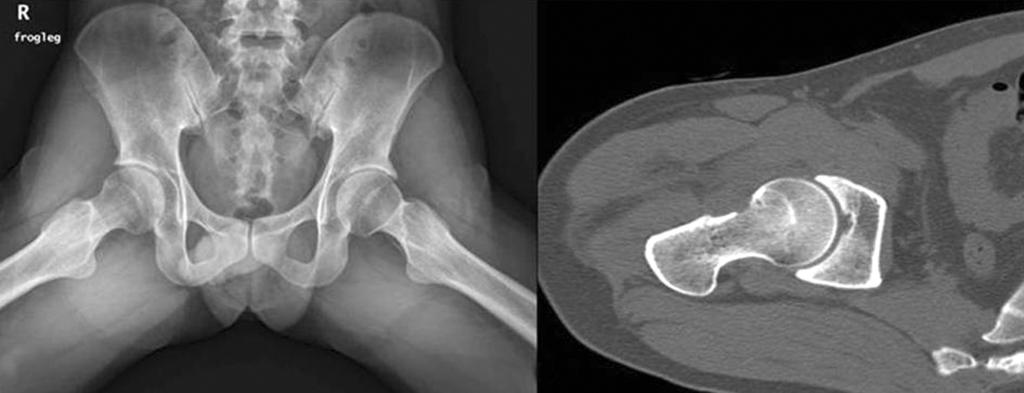 194 이정범ㆍ황득수ㆍ강찬외 1 인 Figure 8. Patient s symptom was aggravated after a minor traffic accident occurred after 6 months, and despite of appro pri ate conservative treatment, symptom didn t relieve.