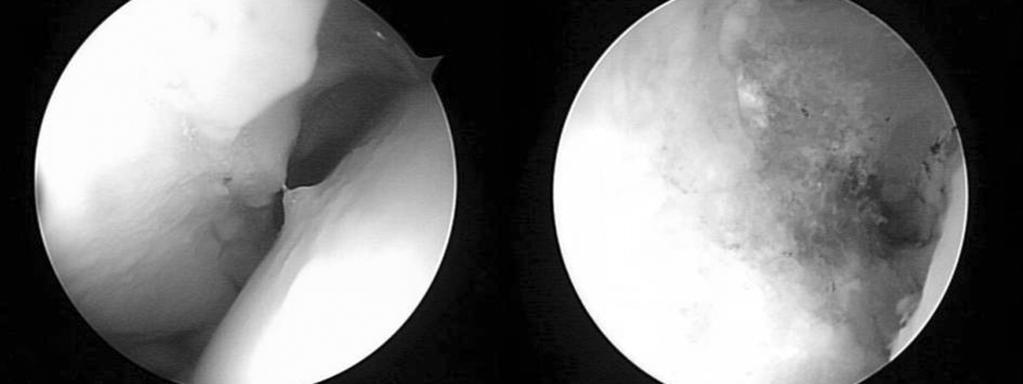 (C, D) Ar throscopic findings show capsulolabral adhesion and remnant labral tear, sug gesting it to be a main factor of the patient s persisting pain. (p-value=0.001).