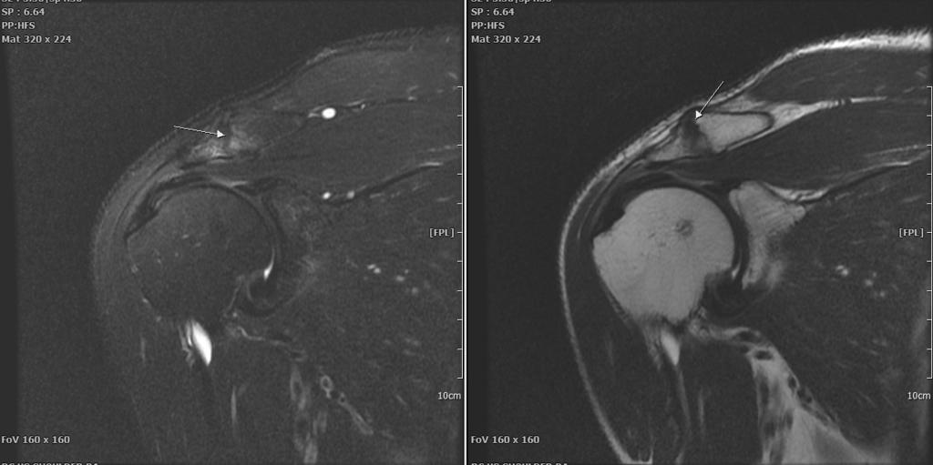 권옥준 김길환 주영국 서지연 송광찬 류원형 전용현 김주원 Fig. 4. Coronal view of Rt. Shoulder MRI (Hypertrophic AC joint).