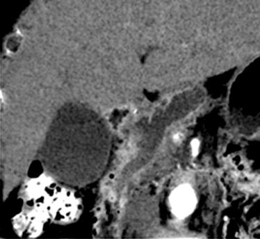 홍혜숙외 1 인. 췌관내유두상점액종양 (IPMN) 의진단 209 Fig. 2. Three-dimensional curved planar reformatted CT images of main duct intraductal papillary mucinous neoplasm, borderline.
