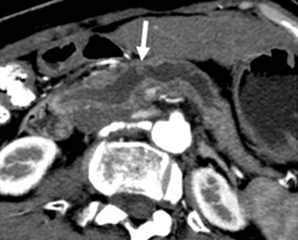 (A) Axial multi-detector row CT image shows a cystic and solid mass with calcifications in the pancreatic head. The solid portion of the mass has infiltrative border to parenchyma (arrow).