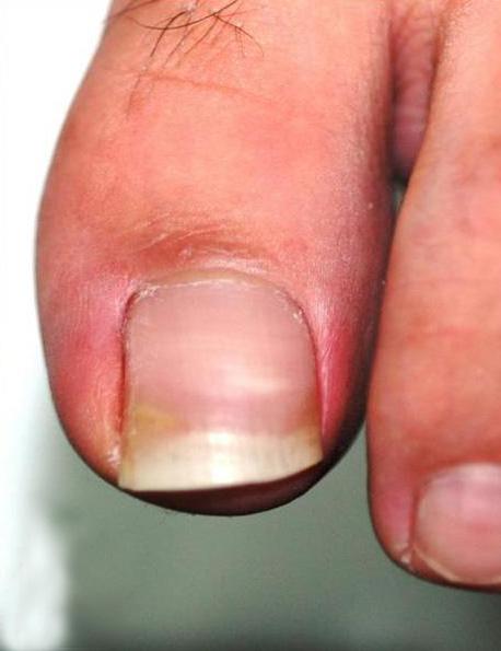 These preoperative and final follow-up clinical photographs show that the severely incurved toenail with growth plate deformity was transformed into a