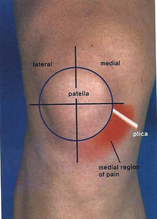활액막추벽 Synovial plica 병리 슬개골내측단의활액막주름비후 증상