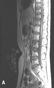 - 대한내과학회지 : 제 71 권부록 3 호 2006 - Figure 2. Sagittal MR images of the T-L spine at the ER. Note the decreased heights of T9-12 and L3-5.