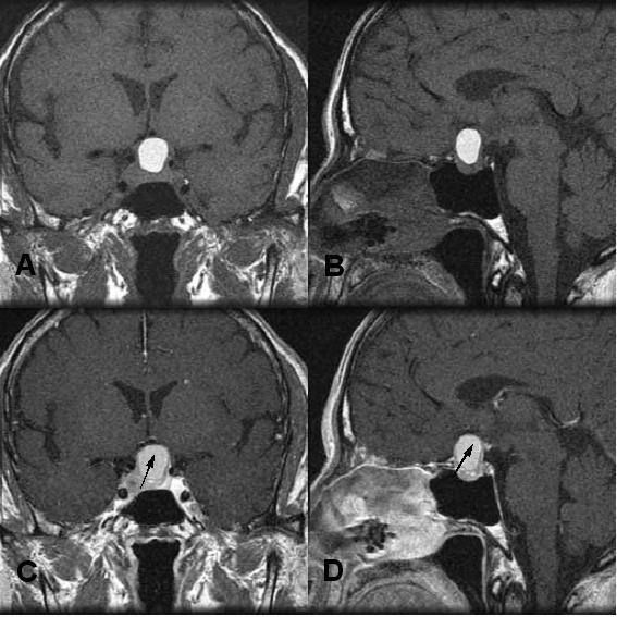 - 대한내과학회지 : 제 72 권제 3 호통권제 559 호 2007 - Figure 3. T1-weighted MR image of the brain.