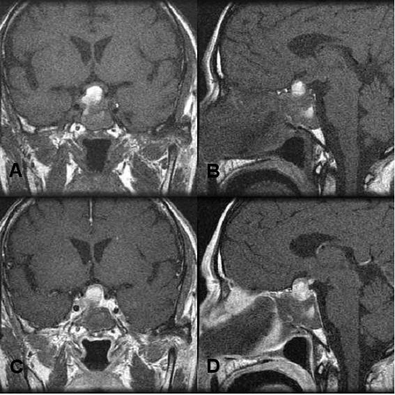 - 이준철외 6 인 : 비기능성뇌하수체종양에연관된항이뇨호르몬분비이상증후군 1 예 - Figure 5. T1-weighted MR image of the brain after the operation.