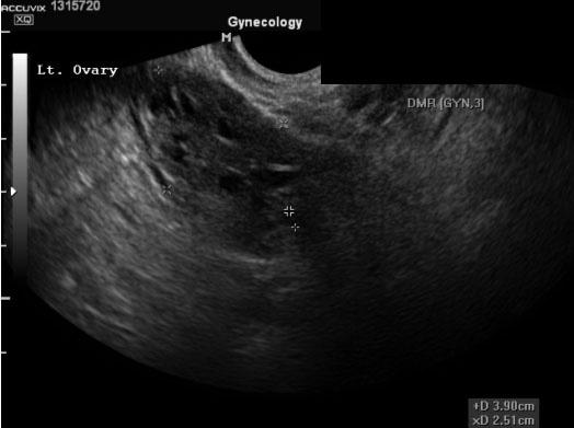 - 다모증을주소로내원하여대사증후군을동반한청소년기다낭성난소증후군으로진단된 2 예 - A B Fig. 3. The small multiple follicular cysts in ovary are detected by transrectal ultrasound.