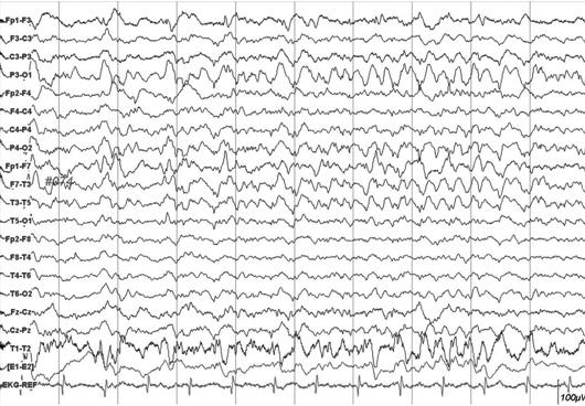 J Neurocrit Care 2010;3:7-12 속상태 (nonconvulsive status epilepticus: NCSE) 나비경련성발작 (nonconvulsive seizure: NCSz) 여부를확인하는데지속뇌파검사가필수적이다.