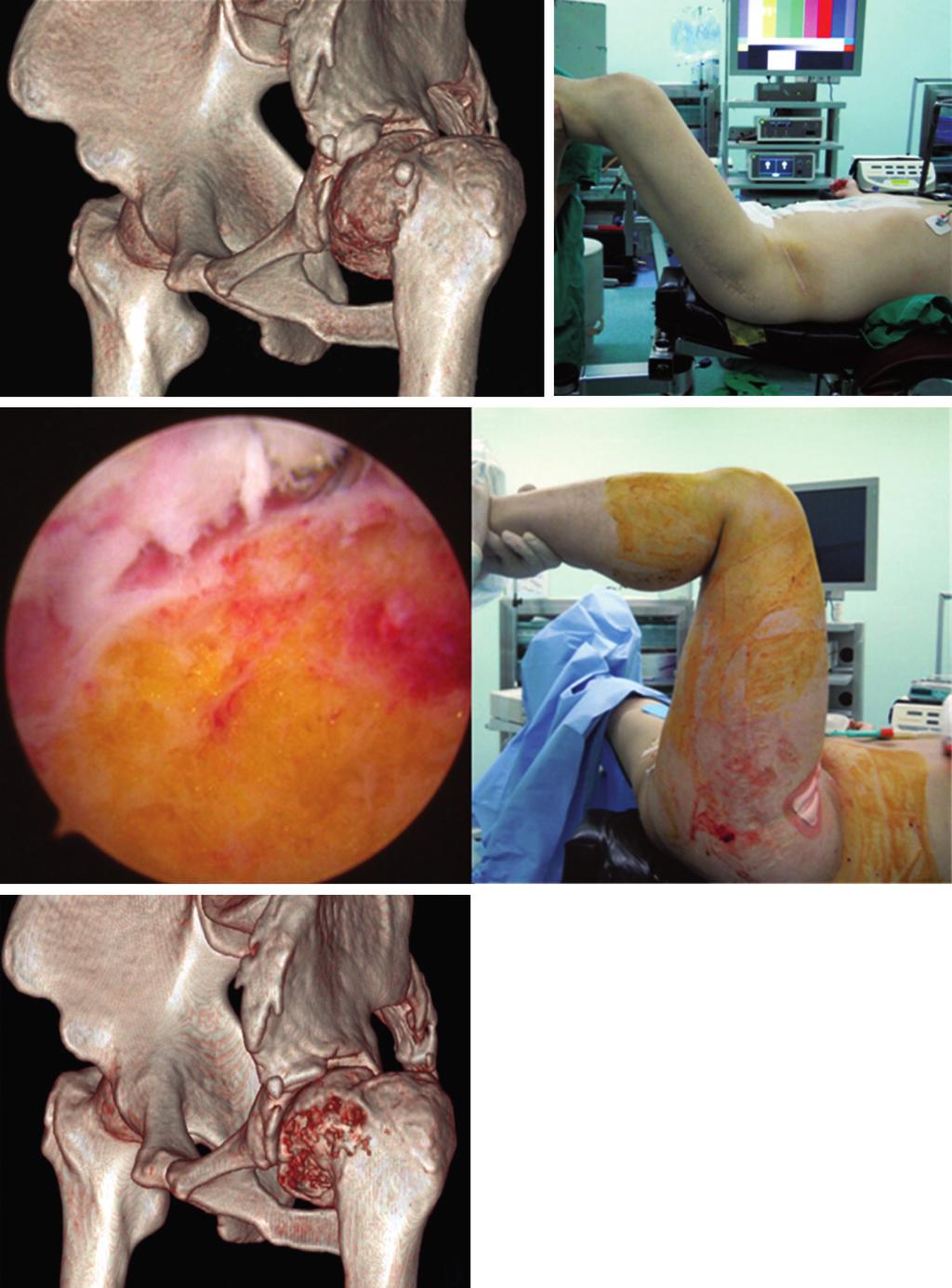 Hip Pelvis 25(2): 121-126, 2013 부터 전방 삽입부까지 관절낭 절개술을 모두 시행하였다. 고관절은 기하학적 형태에 의해 고유의 안정성을 가지고 있는 관절로써 관절낭의 해부학, 기능, 생리학에 대하여는 널리 알려져 있다10,11).