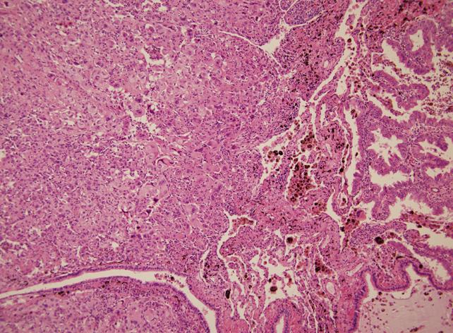 A papillary pattern and undifferentiated diffuse proliferation, suggesting poorly differentiated adenocarcinoma are observed.