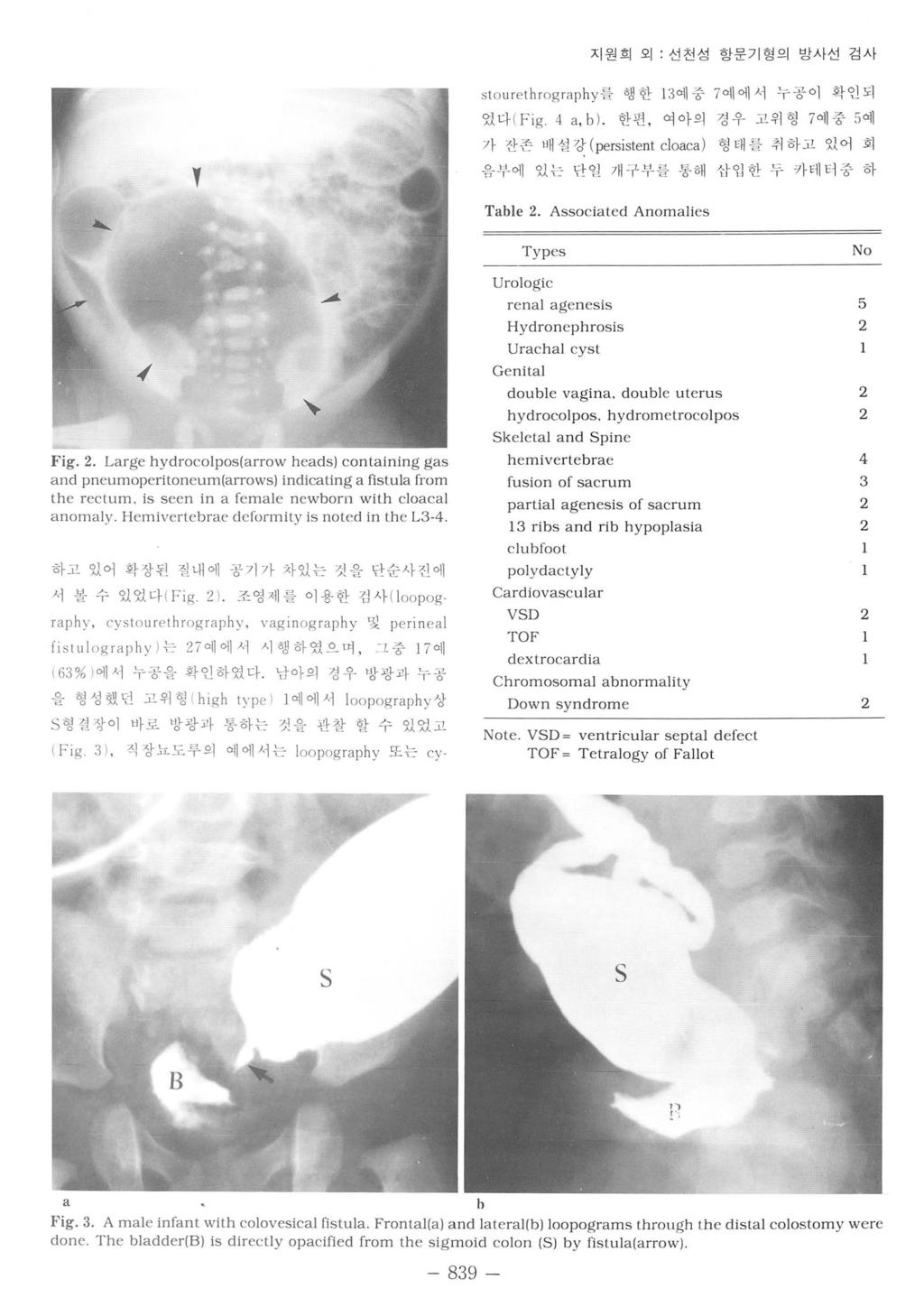 지원희오 선천성항문기형의방사선검사 stou ret h rograph y 를챙한 1 3예중 7 예에서누공이확인되었다 ( Fi g. 4 a, b ). 한편, 여아의경우고위형 7 에중 5 예가잔존배설강 ( persisten t cloaca) 형때를취하고있어회음부에있는단일개구부룹통해십입한두키터1 터중하 ι.( Fig.
