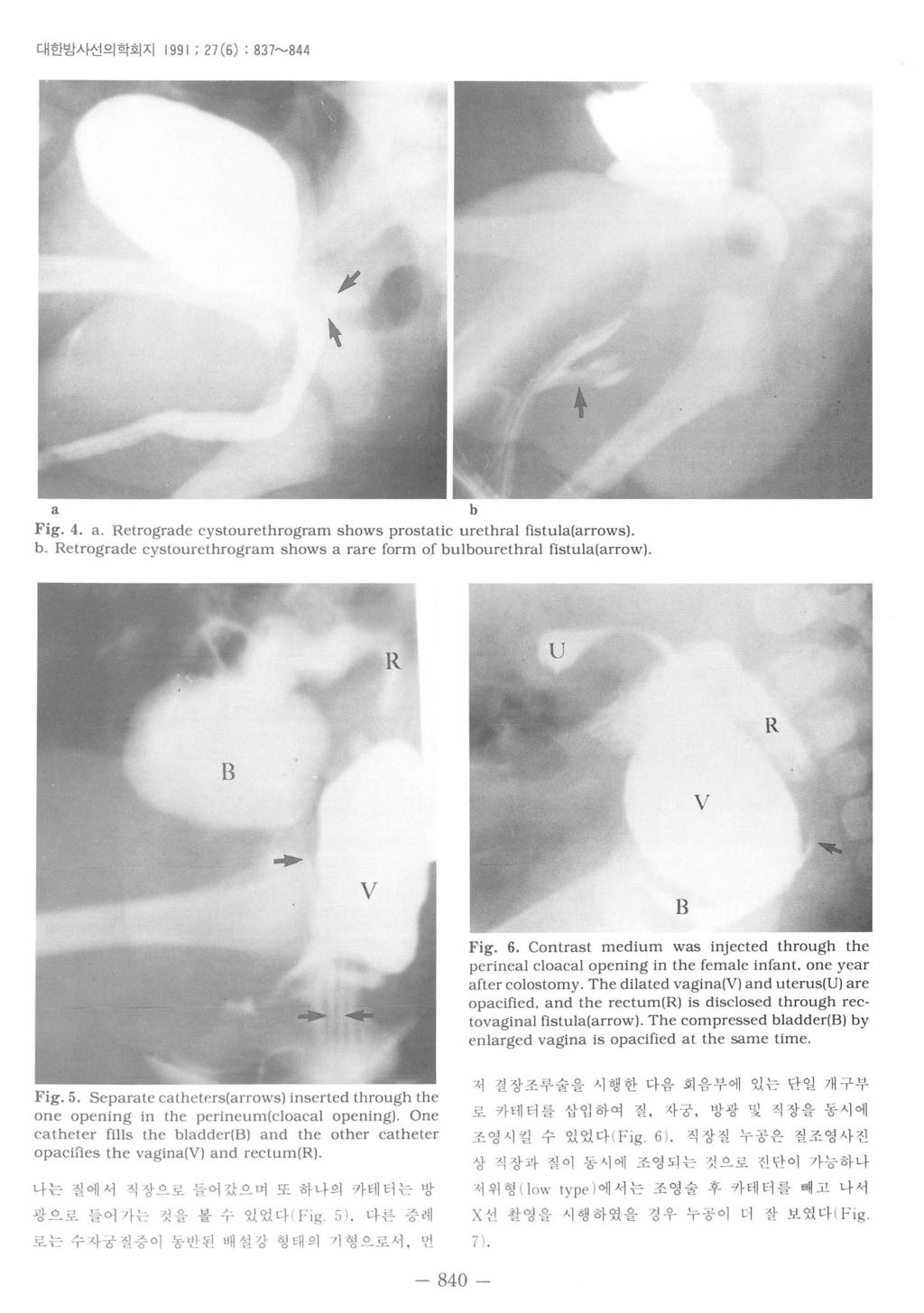 대한방사선의학회지 1991 ; 7 (6) : 837~844 / a b Fig. 4. a. Retrograde cystourethrogram shows prostatic urethral fistula(arrows) b.