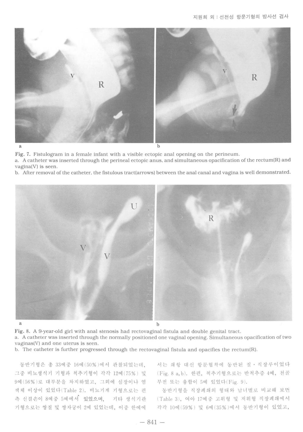 지원희외. 선천성항문기형의방사선검사 V a Fig. 7. Fistulogram in a female infant with a visible ectopic anal opening on the perineum. a. A catheter was inserted through the perineal ectopic anus.
