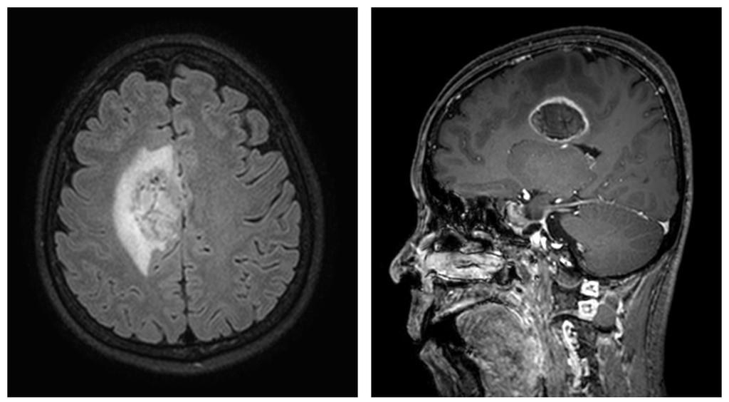 214 Sung-Hyuk Lim, et al. Direct Cortical Stimulation Figure 5. This axial and sagittal MRI study showing a motor region in the right fronto-central lobe. Figure 7.
